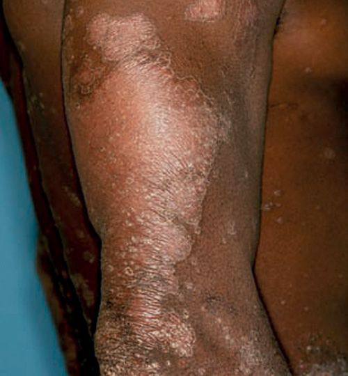 pommade antibactérienne